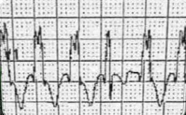 The electrocardiogram shows a form of idiopathic v