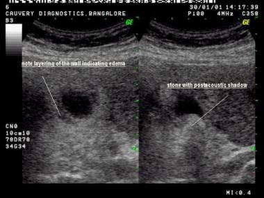 Transverse scans show layering of gallbladder wall