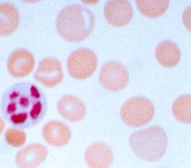 Peripheral smear of blood in a patient with pernic