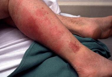 strep throat rash on legs