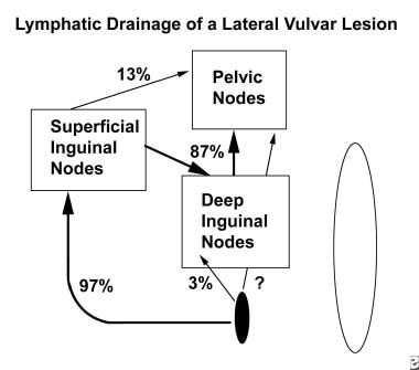 Diagram of lymphatic drainage of a lateral lesion.
