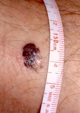 A 1.5-cm melanoma with characteristic asymmetry, i