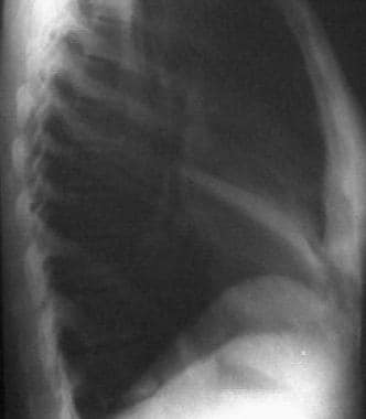Atelectasis. A lateral chest x-ray film confirms t