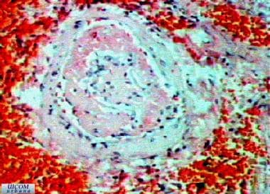 Polyarteritis nodosa (PAN) is characterized by fib