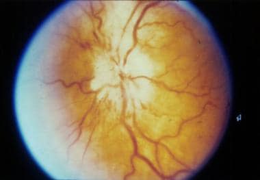 Anterior ischemic optic neuropathy. Image courtesy
