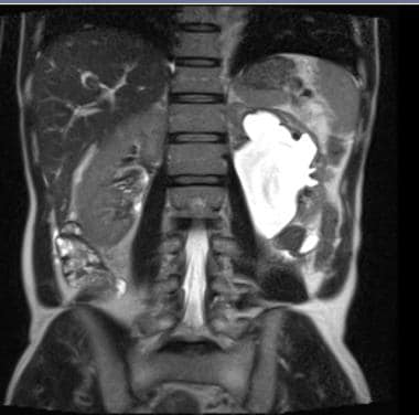 T2-weighted MRI, coronal image, displaying left-si
