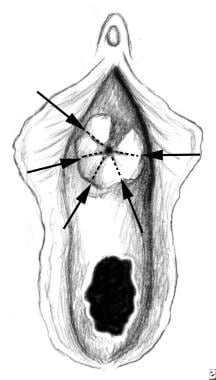 Urethral Prolapse Treatment & Management: Medical Therapy