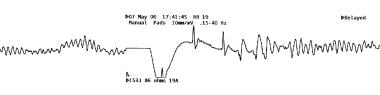 Ventricular fibrillation. Rapidly recurrent despit