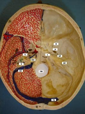 Temporal Bone Fractures Practice Essentials Etiology Presentation