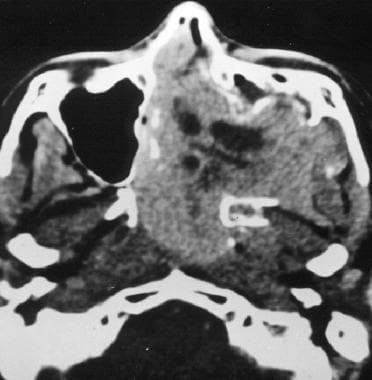 Axial CT scan of lesion involving the right nasal 