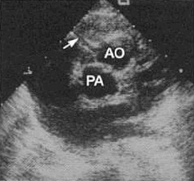 Surgical Approach to Corrected Transposition of th