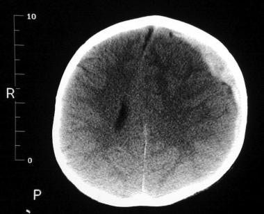 Subdural hemorrhage with midline shift. Image cour