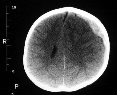 急性硬膜下移位。图片由Lawre提供