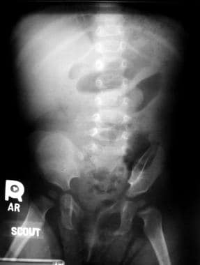 Note intussusception in the left upper quadrant on