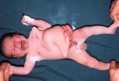 An example of parasitic twin, in which the head is