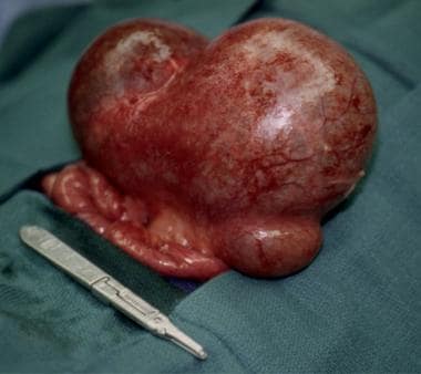Large mesenteric cyst arising from the small-bowel