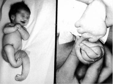 An infant with distal arthrogryposis type I. Note 