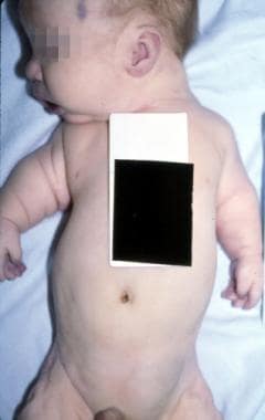 An infant with Jeune syndrome. Note the narrow che