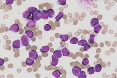 Bone marrow aspirate from a child with T-cell acut