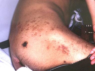 Old herpes zoster and Kaposi sarcoma in a patient 