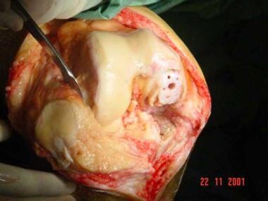 Revision to a total knee arthroplasty; view after 