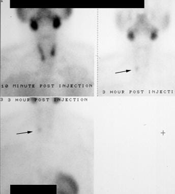 Hyperparathyroidism. Technetium-99m (99mTc) sestam