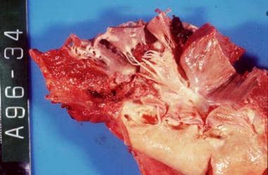 Acute bacterial endocarditis caused by Staphylococ