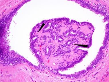 intraductal papilloma pathology outlines