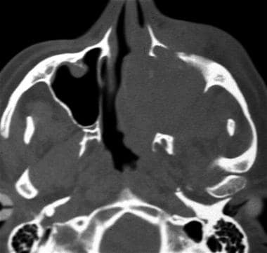 CT scan of a patient with a maxillary sinus tumor 