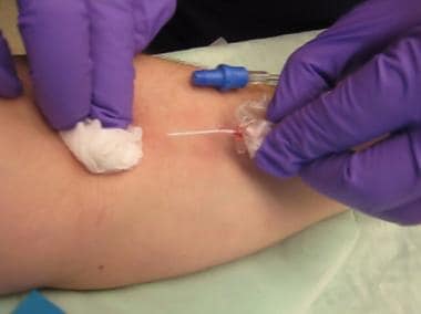 Removal of IV catheter. 