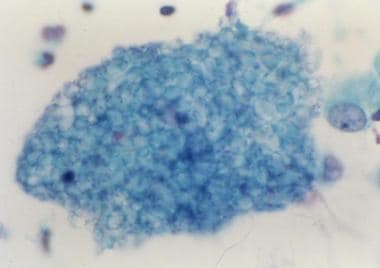 Papanicolaou smear of Pneumocystis jiroveci. 