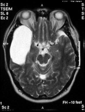 Axial T2-weighted MRI image through the midbrain, 