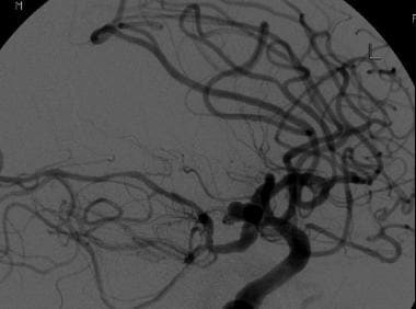 This patient subsequently underwent a CTA and subs