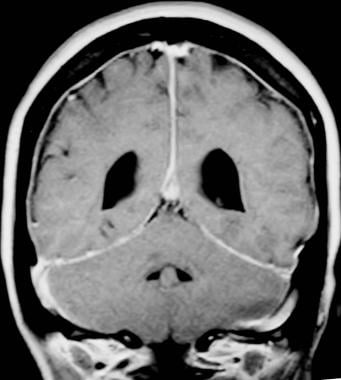 Gadolinium-enhanced, coronal, T1-weighted MRI show
