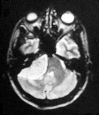T2-weighted magnetic resonance image shows a hyper