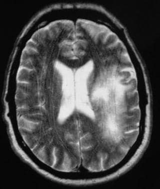 T2-weighted MRI in a patient infected with HIV dem