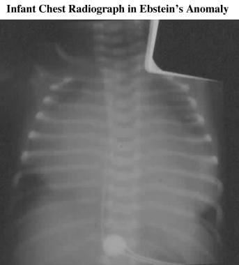 Frontal chest radiograph in an infant with severe 