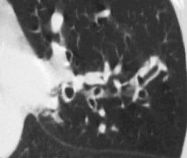 Relationship between the presence of bronchiectasis and acute exacerba |  COPD