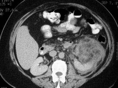 Lymphangioleiomyomatosis. Large angiomyolipoma of 