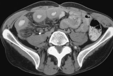 Crohn disease. Active small-bowel inflammation. CT