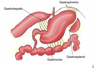 paraesophageal hernia with gastric volvulus