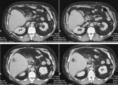 Contrast-enhanced CT scan in a patient who had und