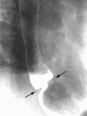 Schatzki ring on an erect, double-contrast barium 