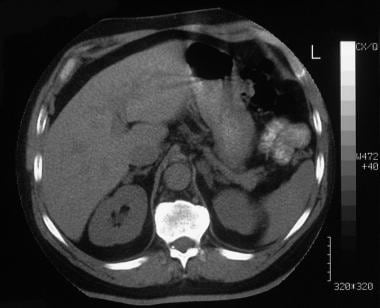 Axial nonenhanced CT scan through the adrenal glan