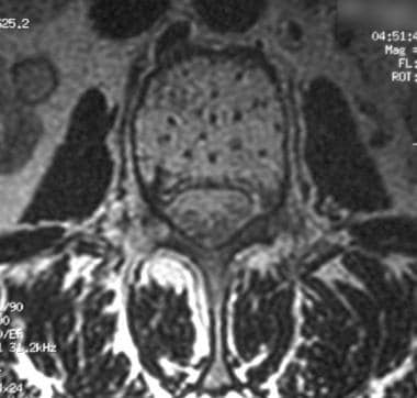 Bone hemangioma. Axial T2-weighted MRI shows the M