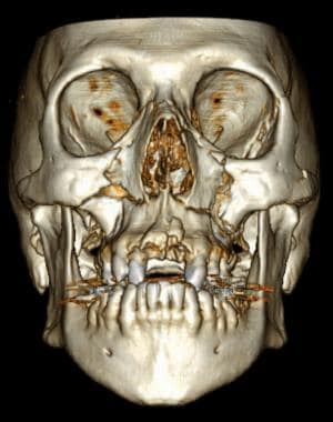 le fort fracture x ray