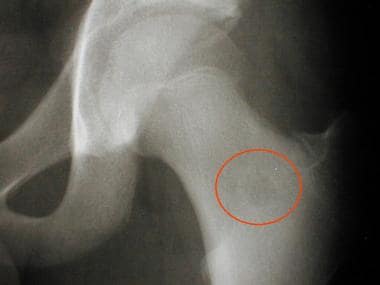 Radiograph of the left hip in a 14-year-old boy. T