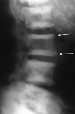 Lateral radiograph of the spine in a patient with 