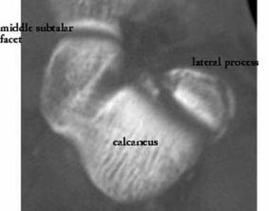 Lateral process fracture. Axial computed tomograph