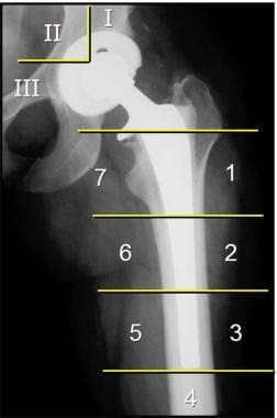This anteroposterior radiograph shows the numbered